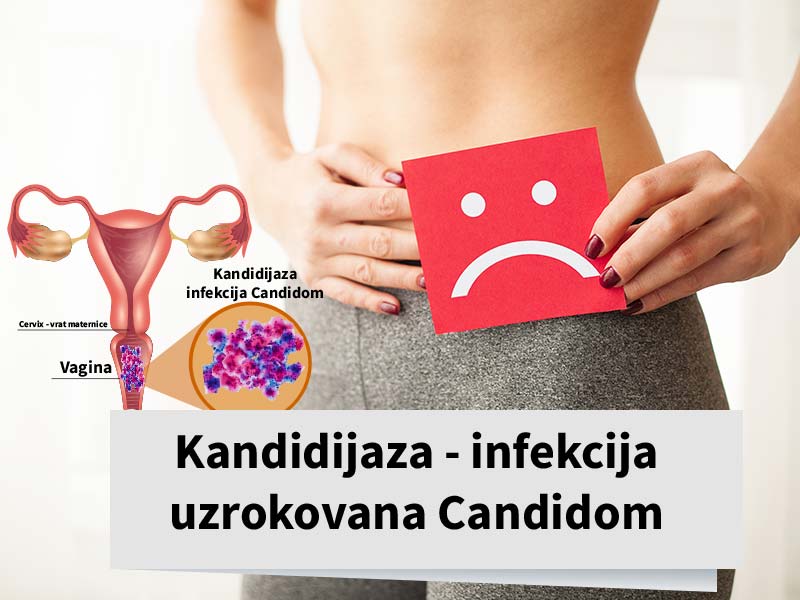 Pročitajte više o članku Kandidijaza – infekcija uzrokovana Candidom